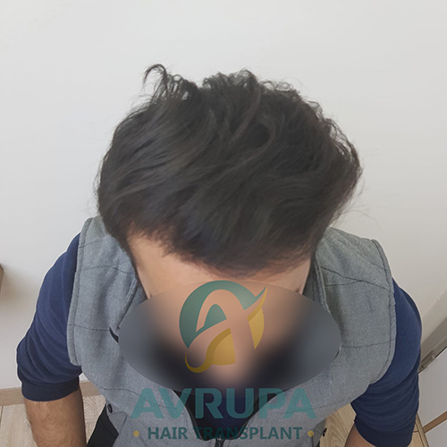 Before and After  graft    transplant at 