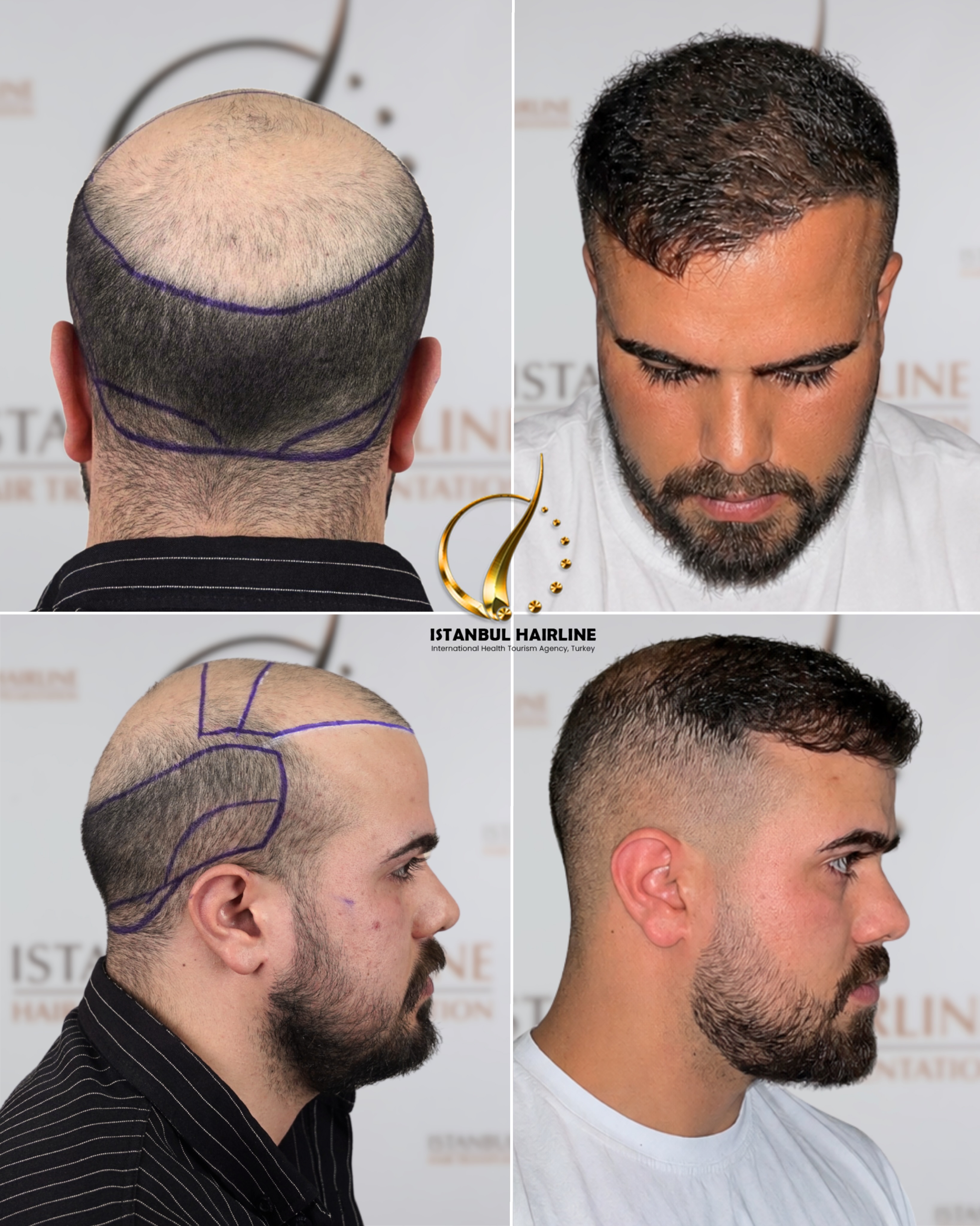 Before and After  graft    transplant at 