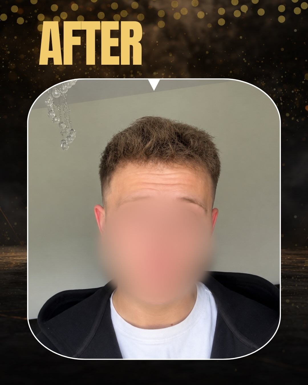 4600 graft DHI hair transplant result before and after