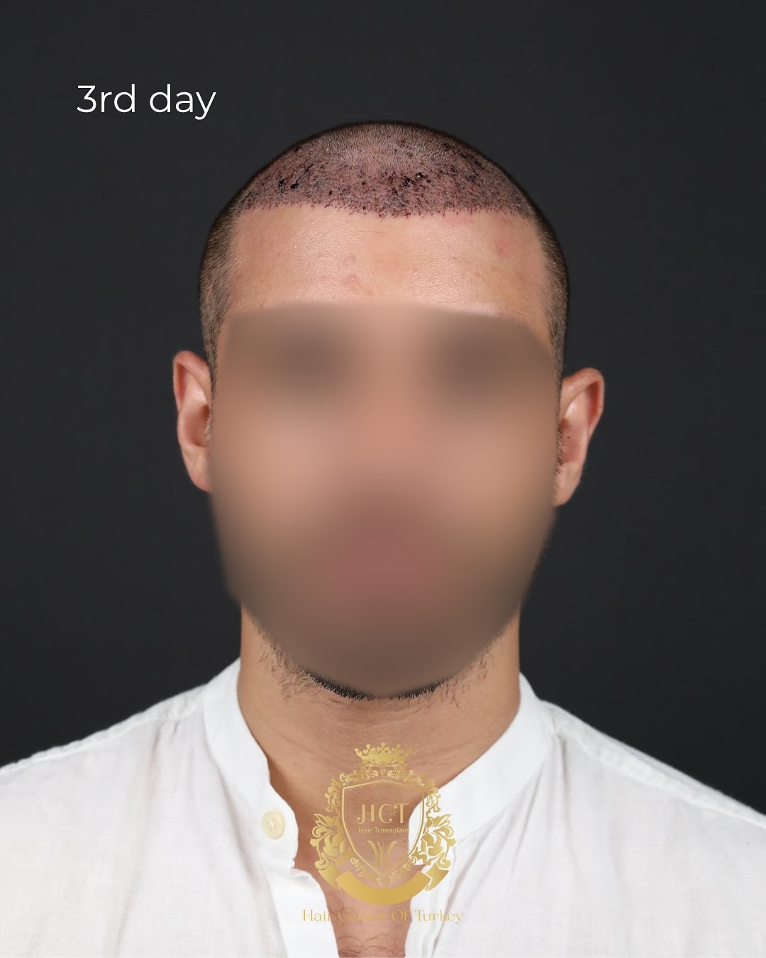 Before and After  graft    transplant at 