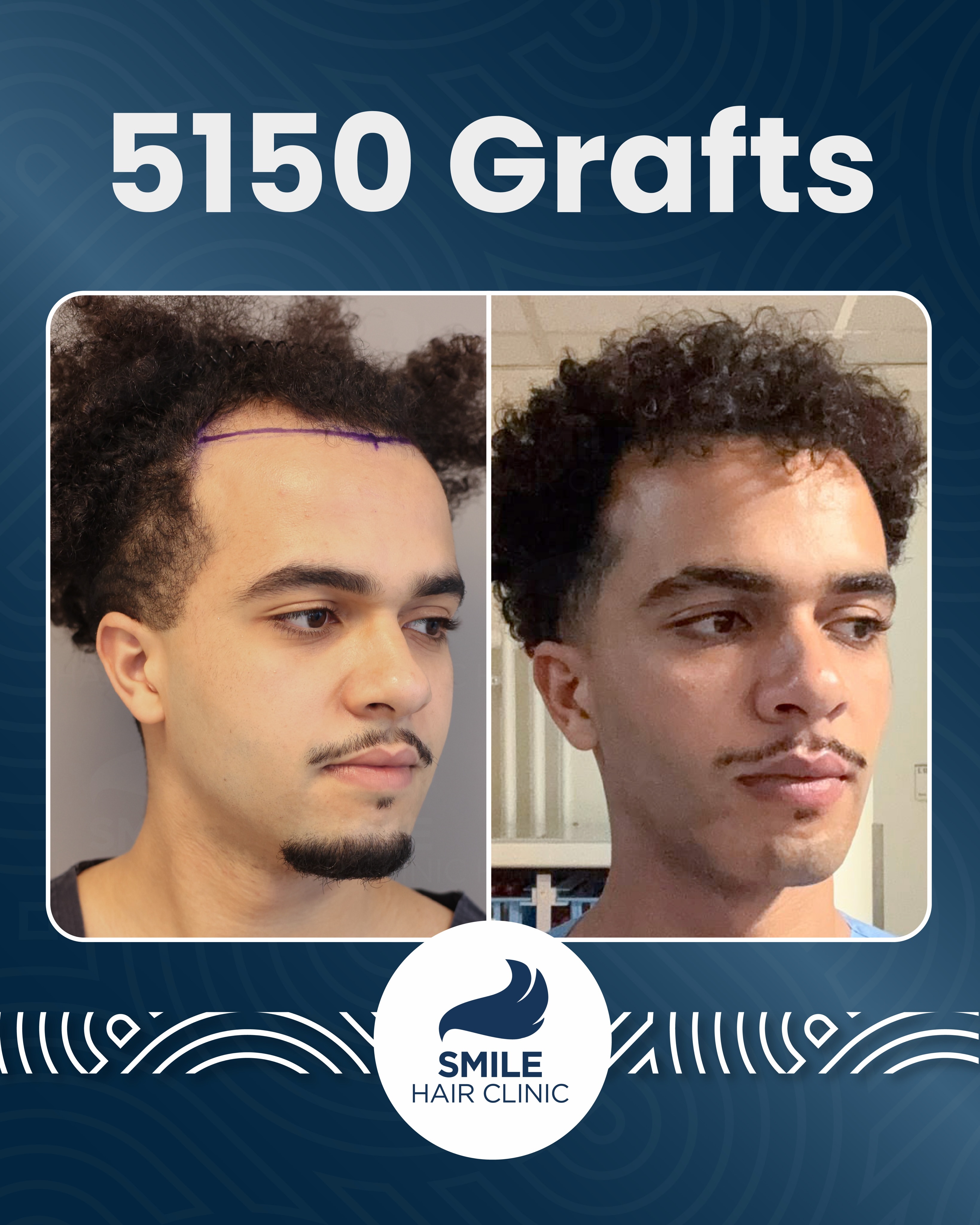 Before and After  graft    transplant at 
