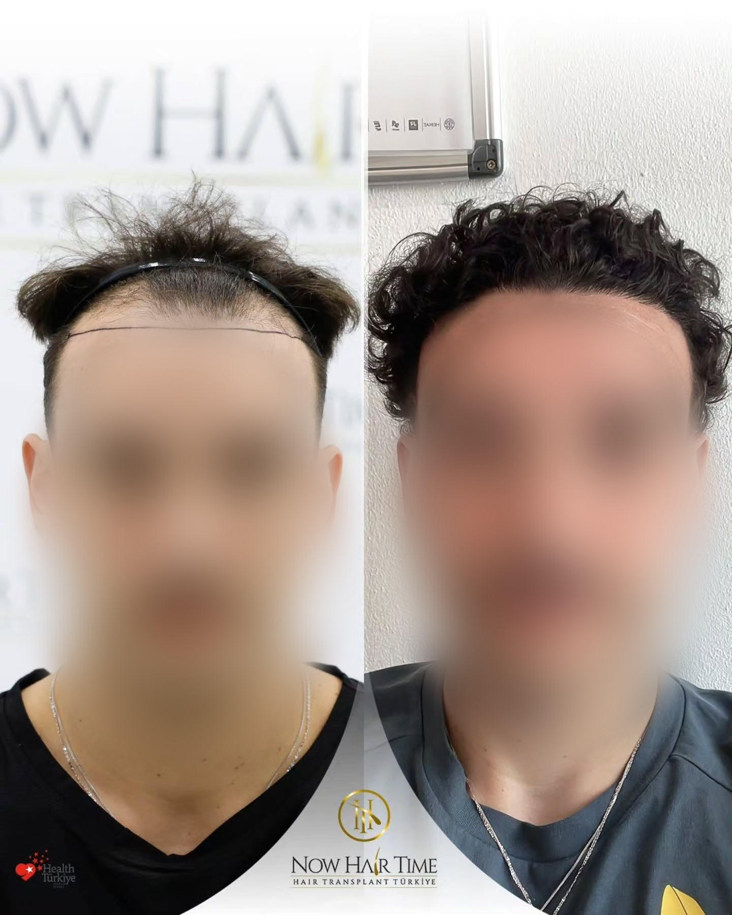 Before and After 4500 graft  SAFIR hair transplant at Now Hair Time Hair Transplant in Turkey
