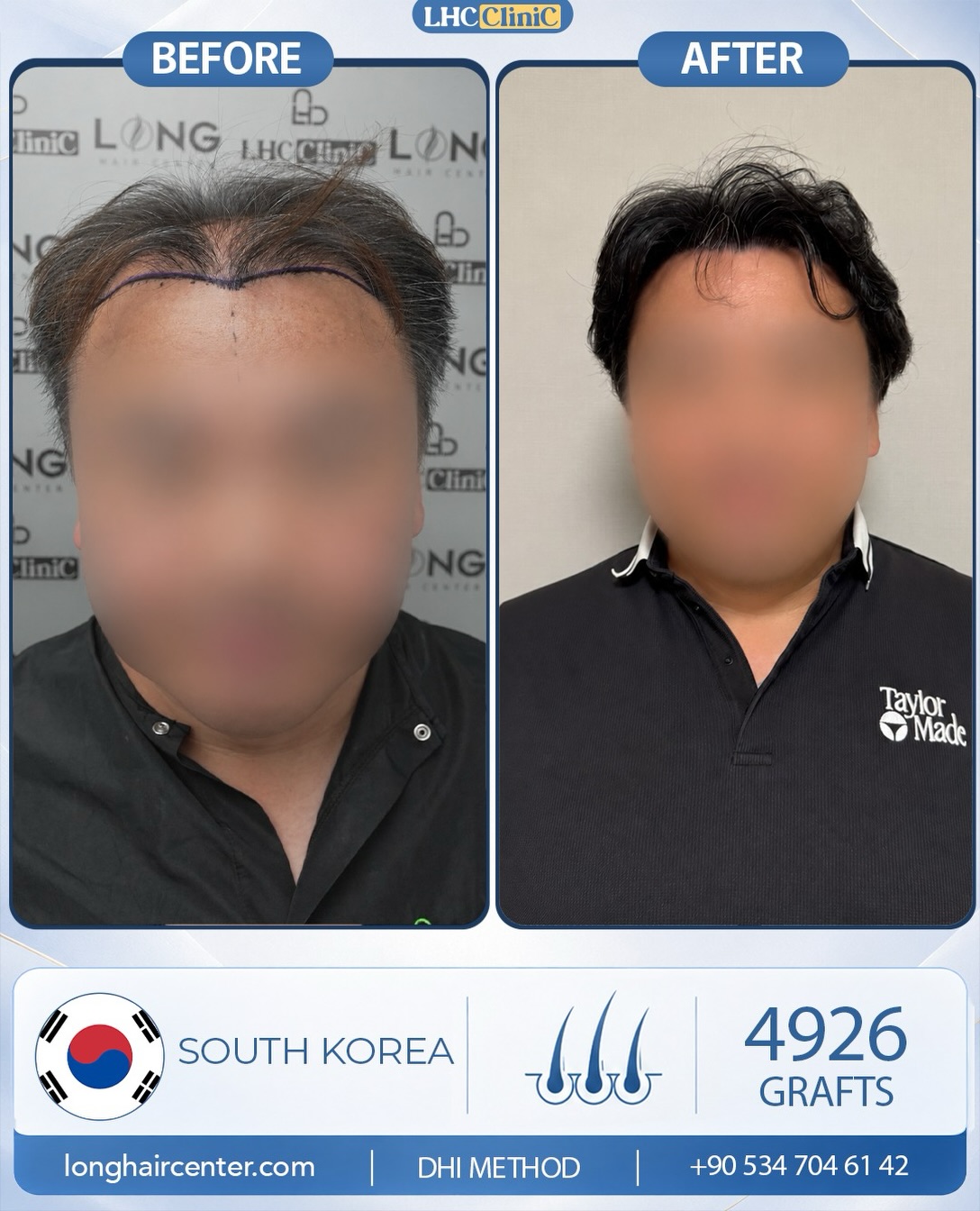 Before and After  graft    transplant at 