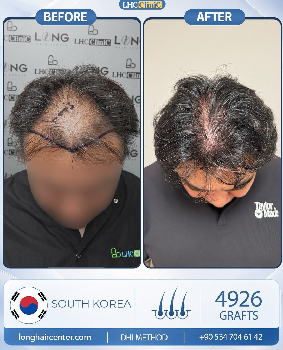 4926 graft DHI hair transplant result before and after