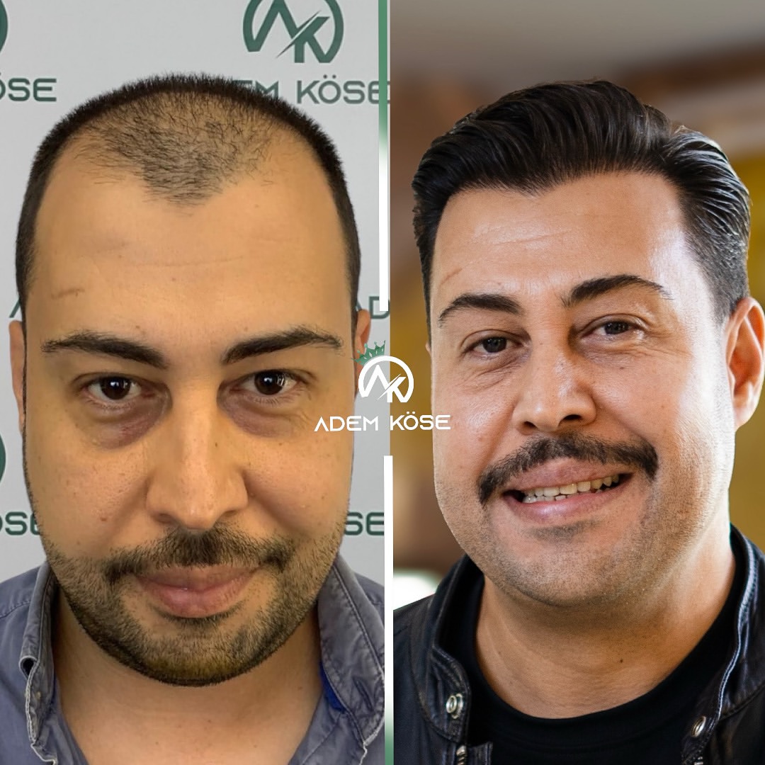 FUE Hair Transplant Result