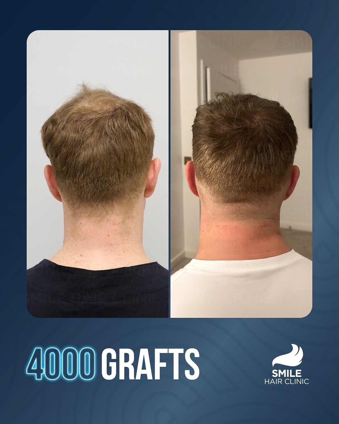 Before and After  graft    transplant at 