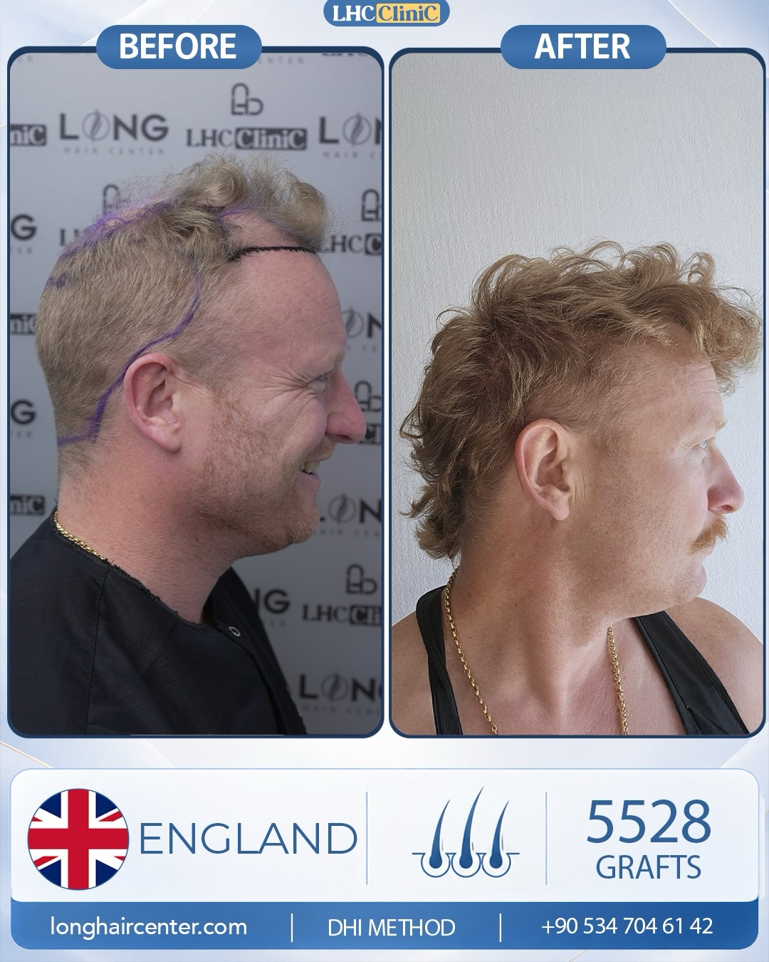 5528 grafts DHI hair transplant result before and after
