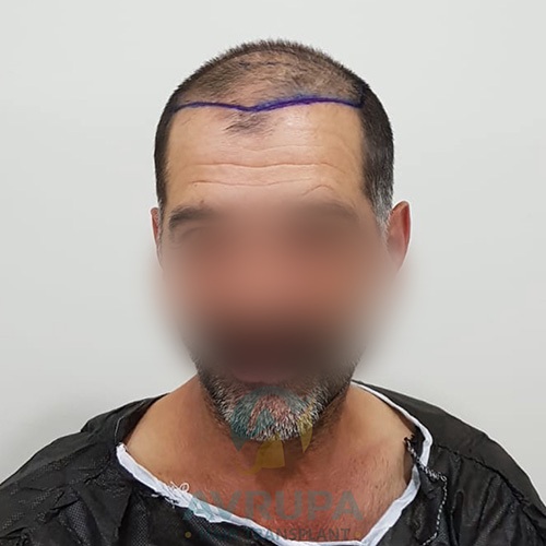 Before and After  graft    transplant at 