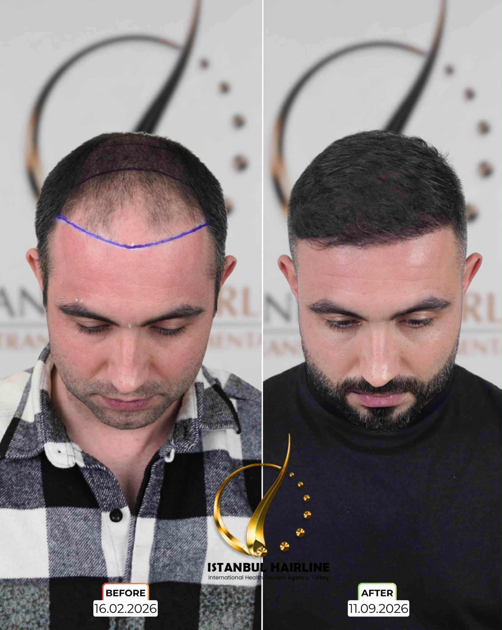 Before and After  graft    transplant at 