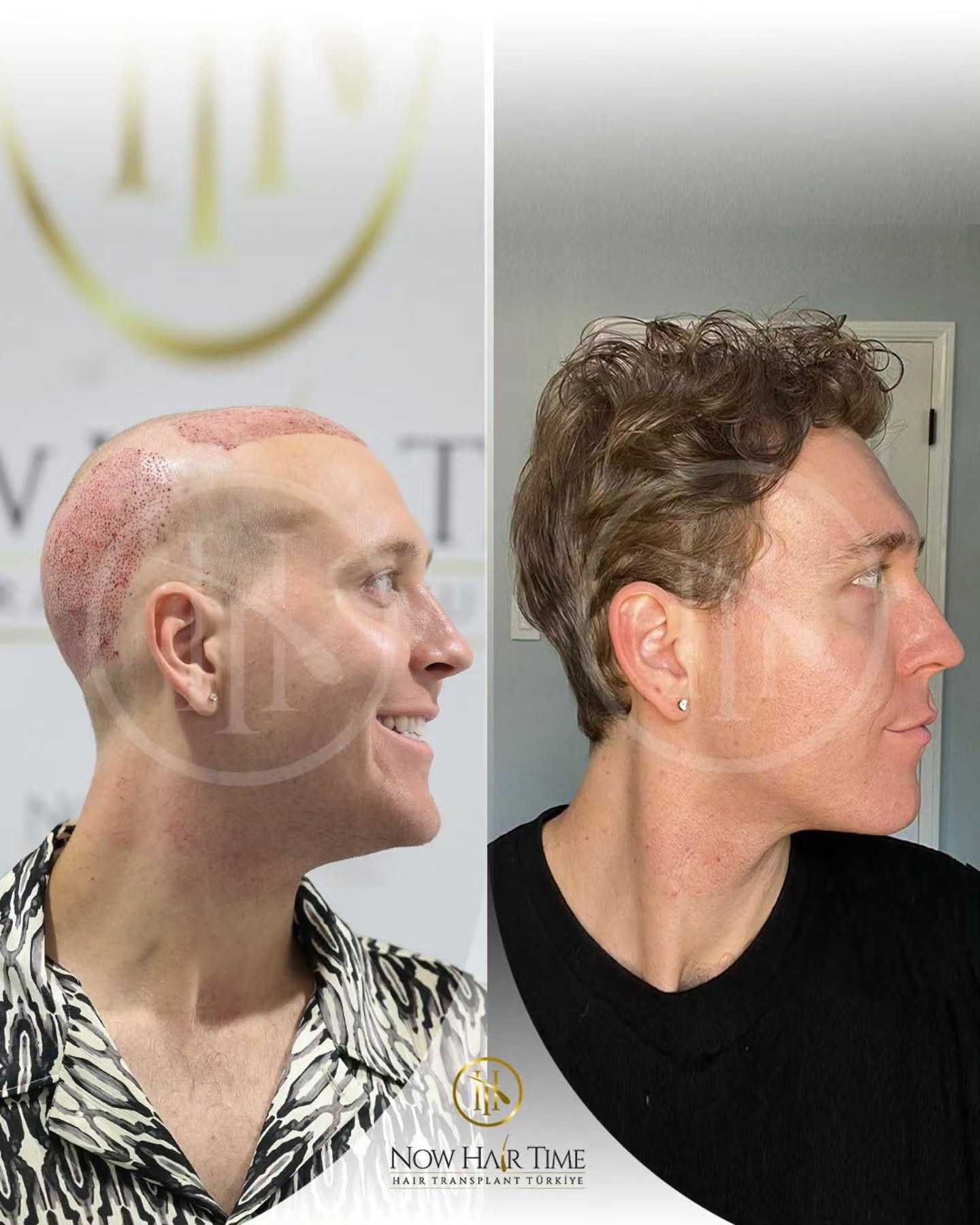 Before and After  graft    transplant at 