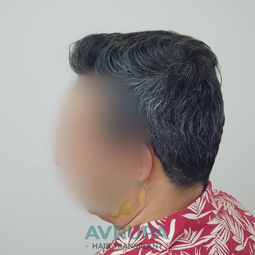 4100 graft FUE hair transplant result before and after
