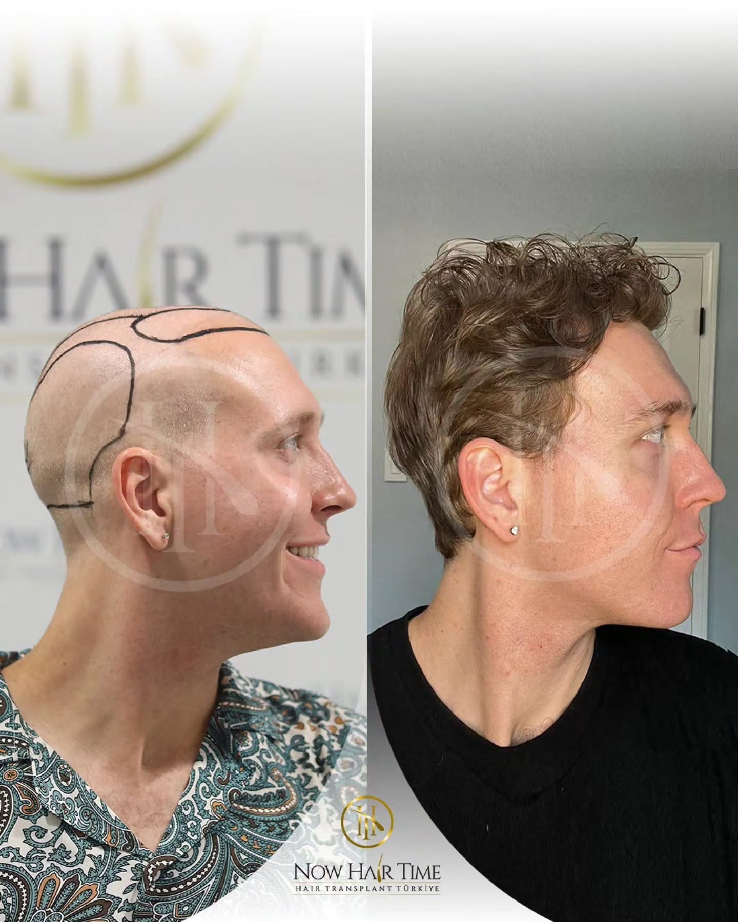 Before and After  graft    transplant at 