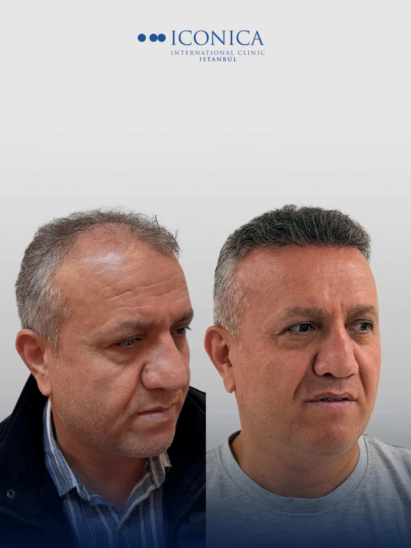 Before and After  graft    transplant at 