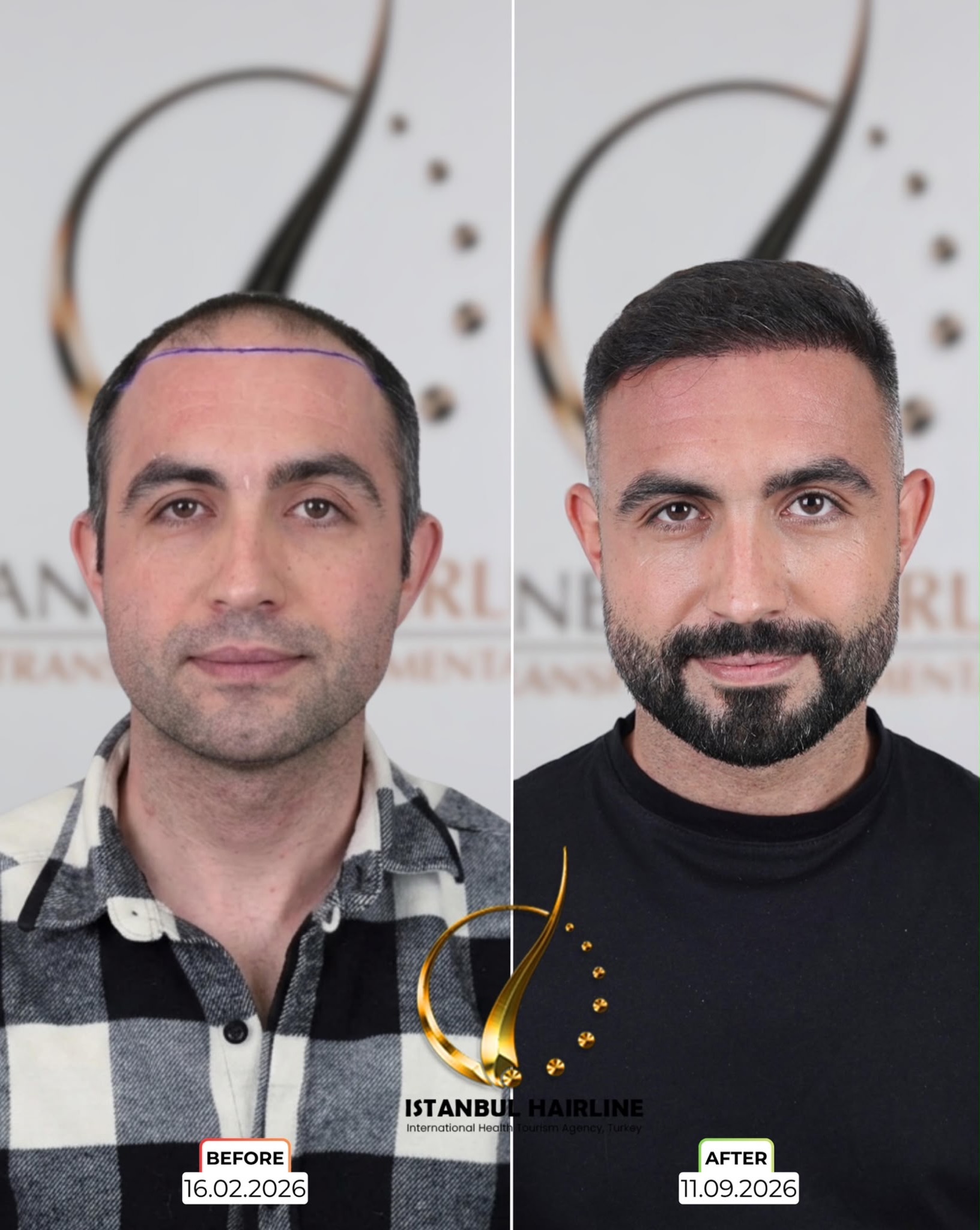Before and After 5500 graft  HYBRID hair transplant at İstanbul Hairline | Saç Ekimi Merkezi