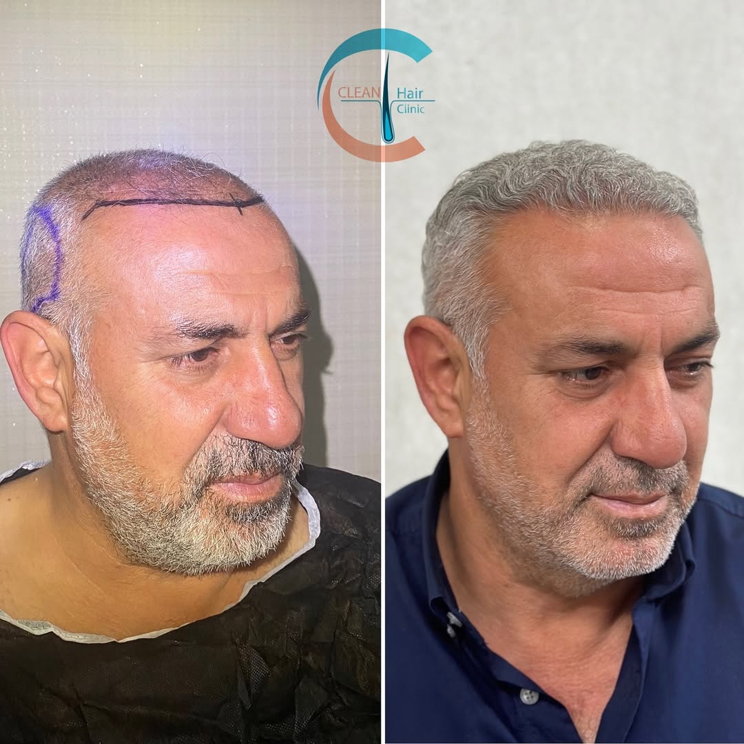 FUE Hair Transplant Result