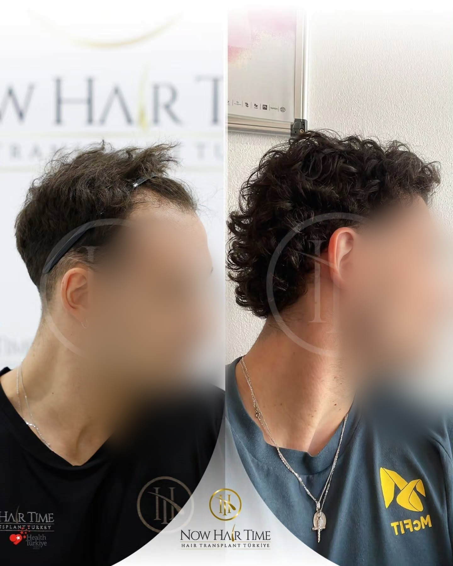 Before and After  graft    transplant at 