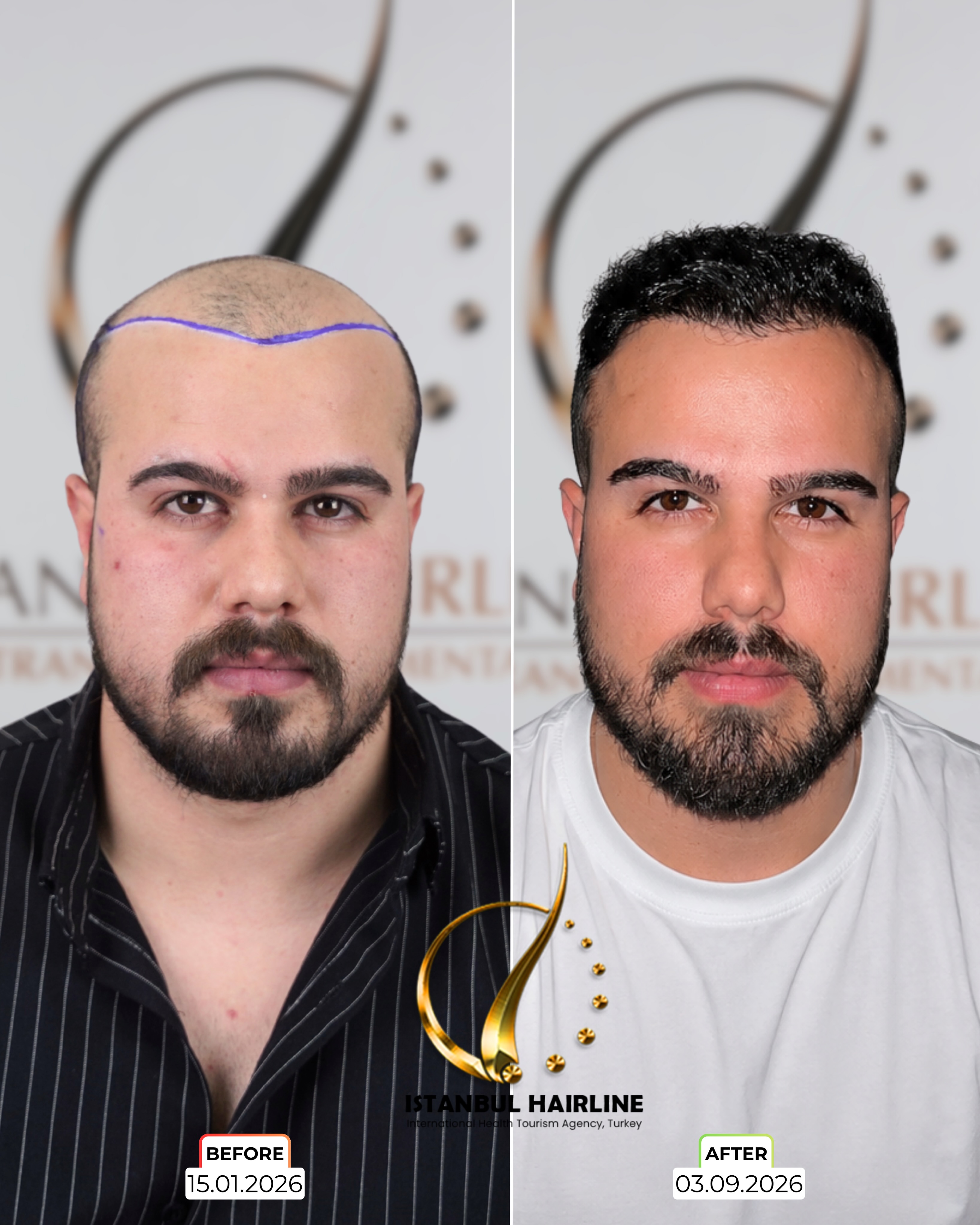 Before and After 4900 graft  SAFIR hair transplant at İstanbul Hairline | Saç Ekimi Merkezi