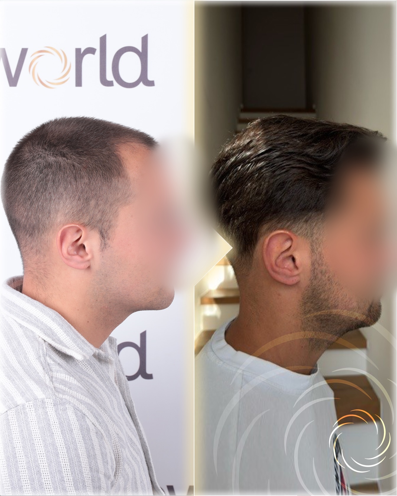 Before and After  graft    transplant at 