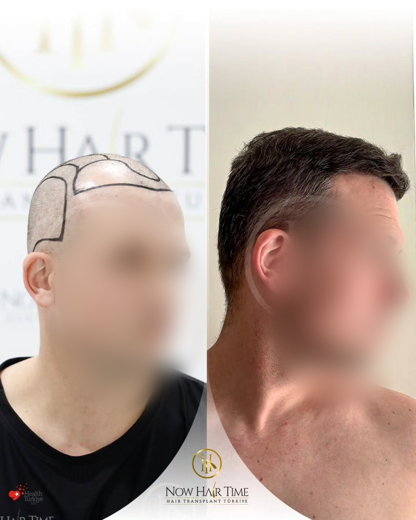 Before and After  graft    transplant at 