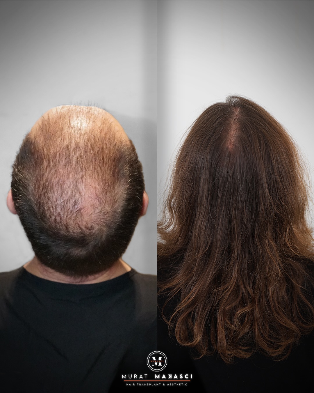 Before and After  graft    transplant at 