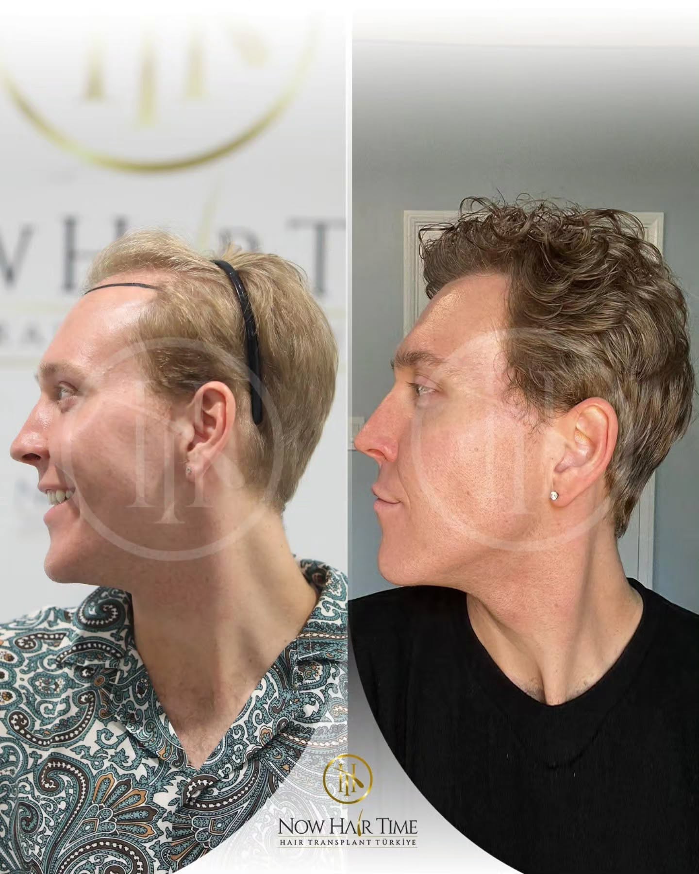 Before and After  graft    transplant at 