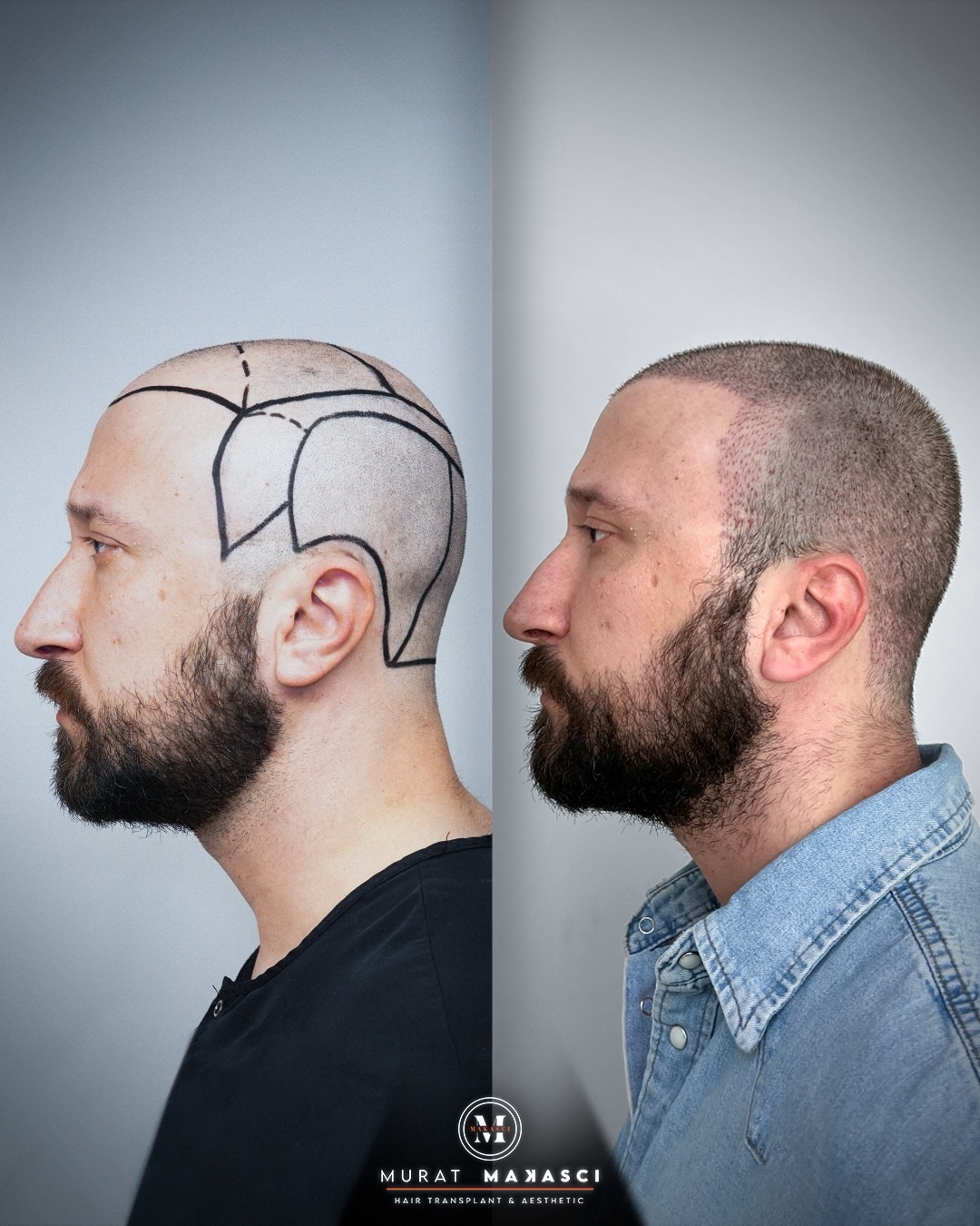 Before and After  graft    transplant at 