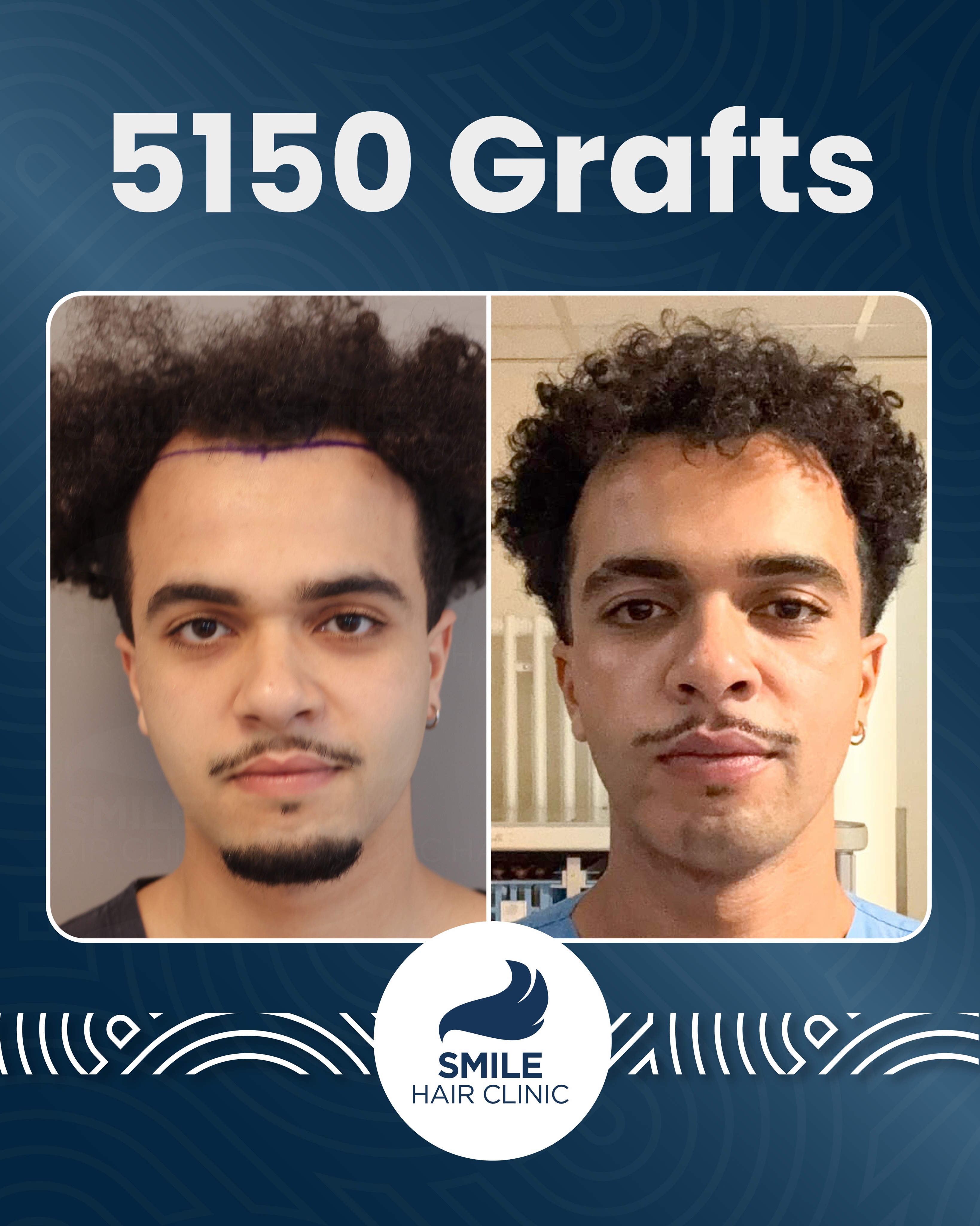 5150 grafts FUE hair transplant result before and after