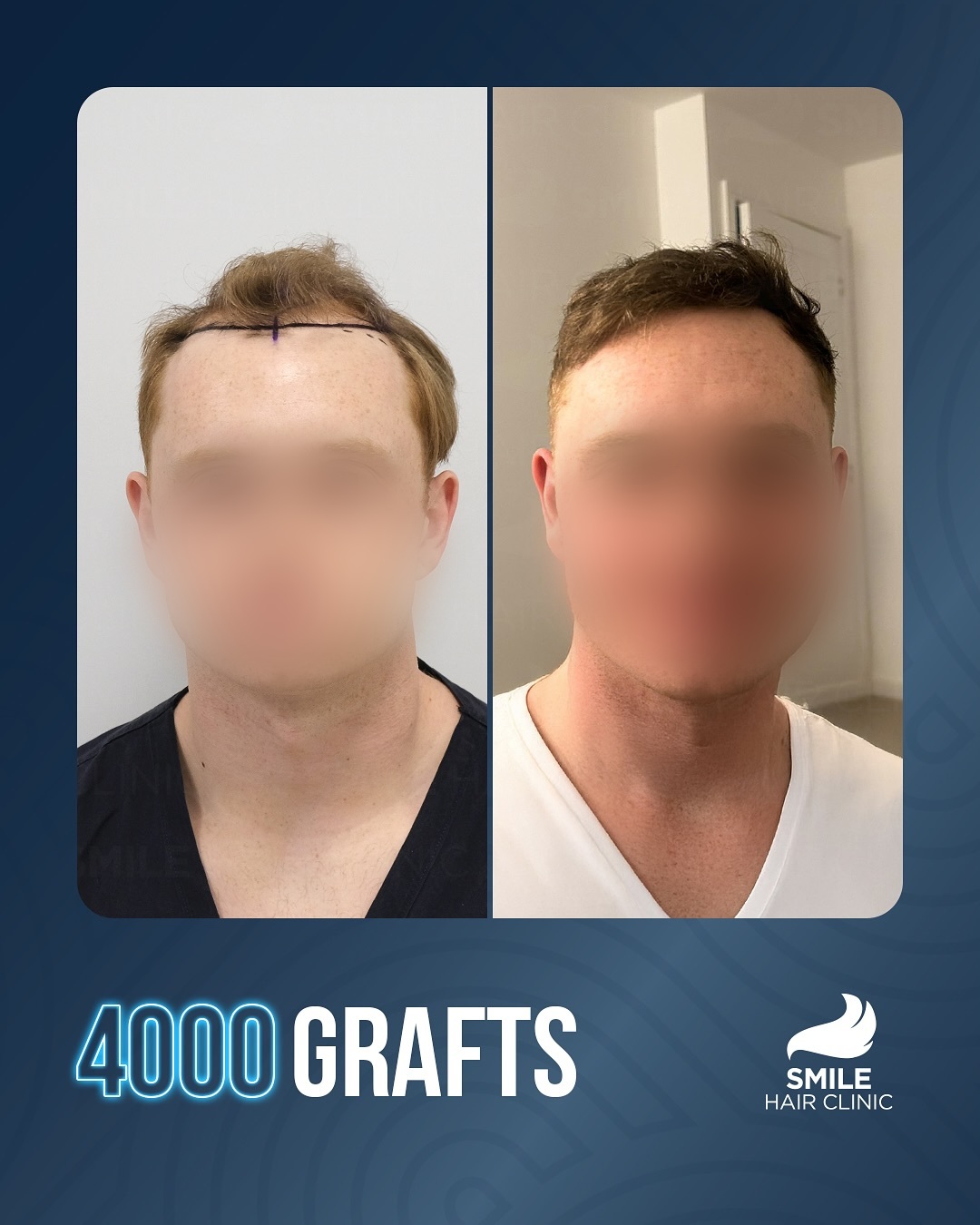 4000 graft FUE hair transplant result before and after