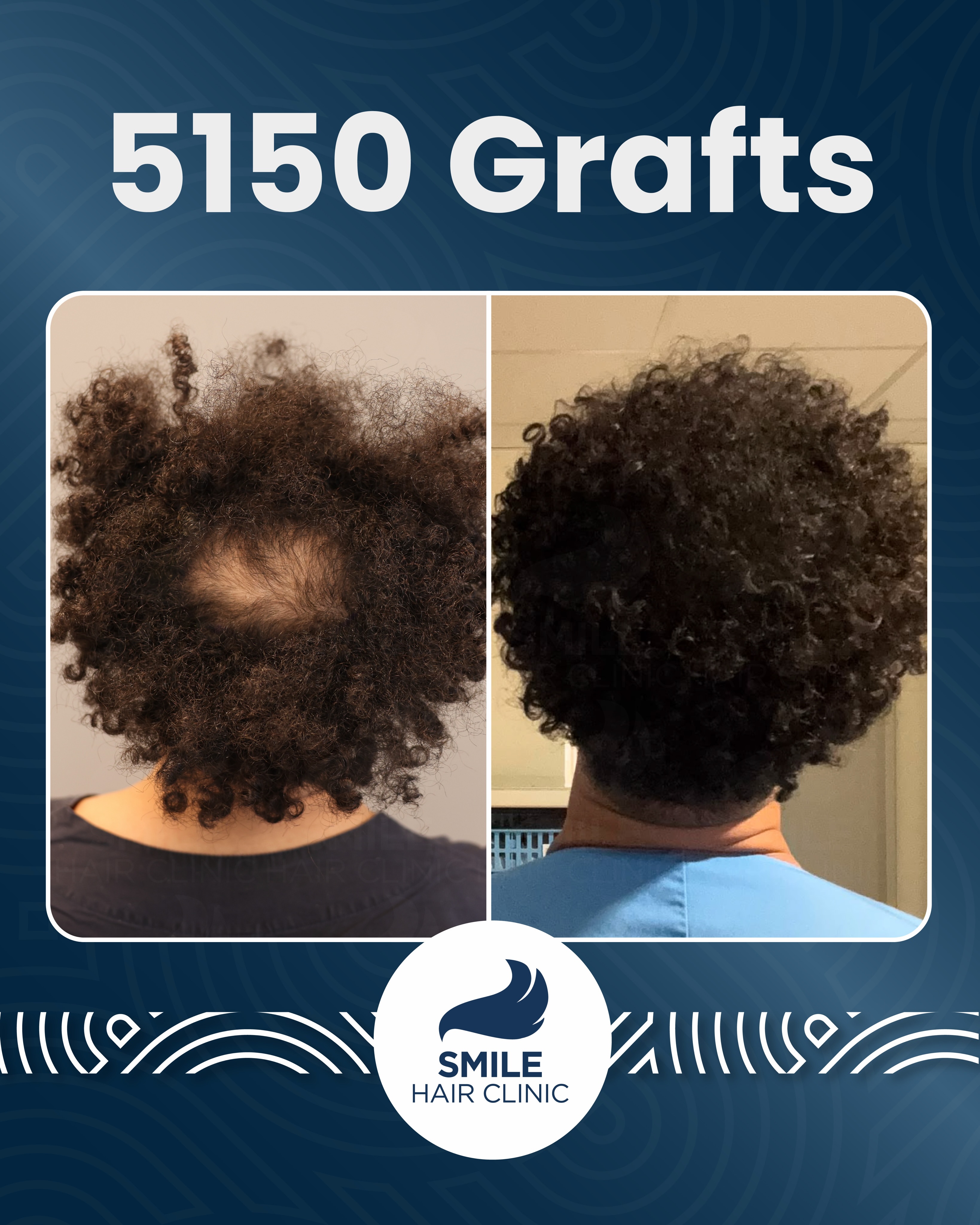 Before and After  graft    transplant at 