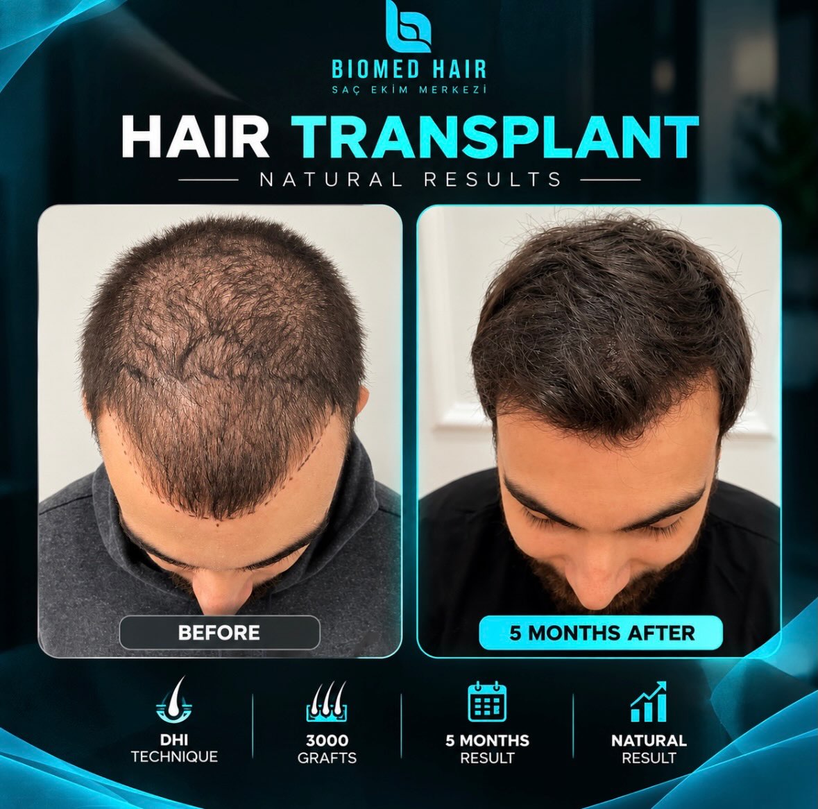 3000 graft DHI hair transplant result before and after