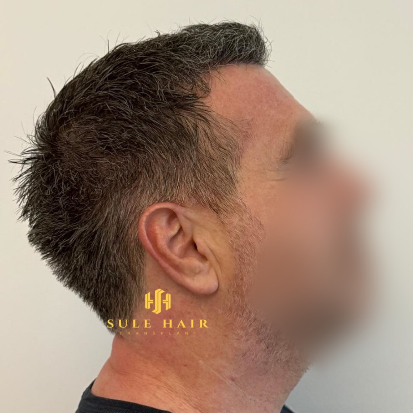 Before and After  graft    transplant at 