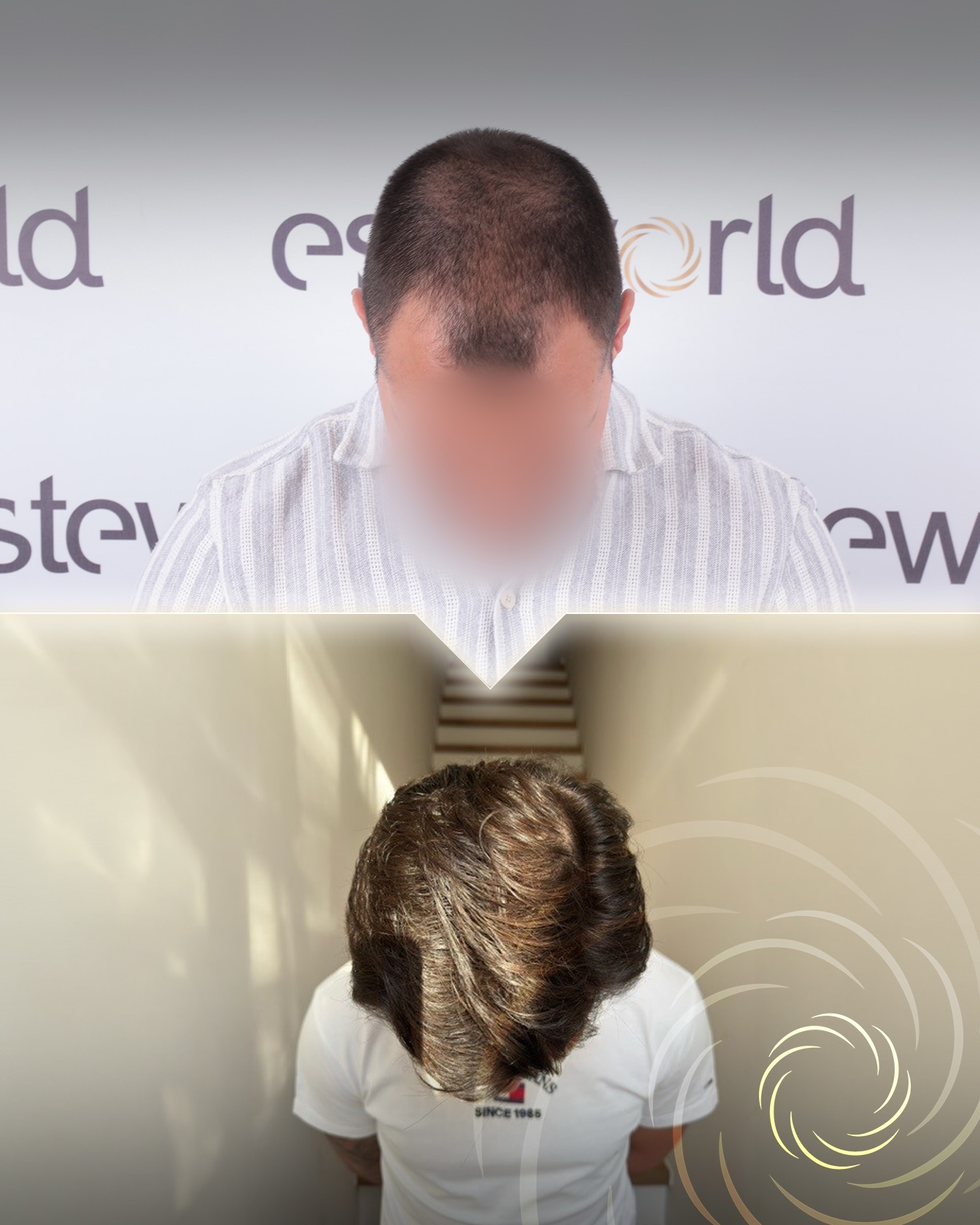 3600 graft DHI hair transplant result before and after