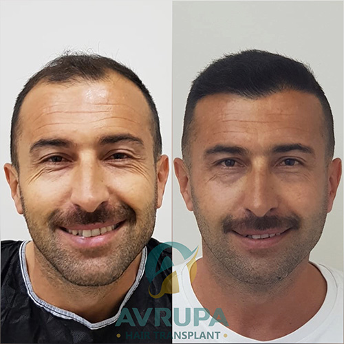 FUE Hair Transplant Result