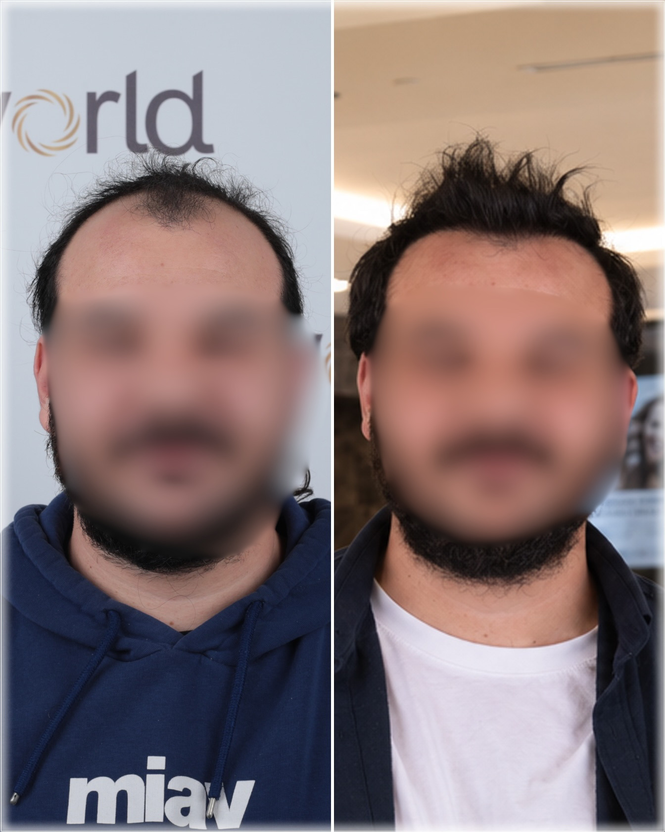 4570 graft DHI hair transplant result before and after