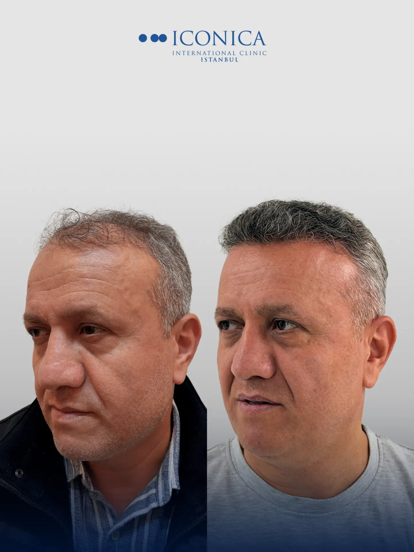 Before and After  graft    transplant at 