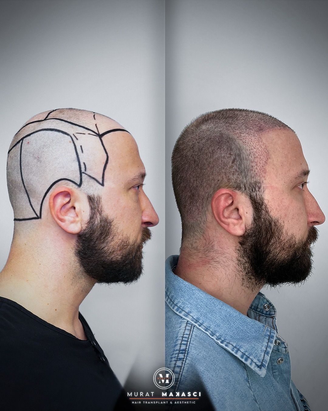 Before and After  graft    transplant at 