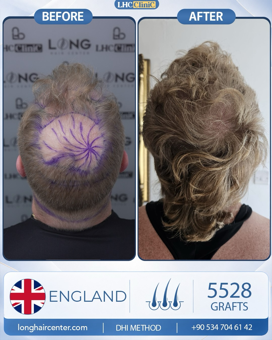 Before and After  graft    transplant at 
