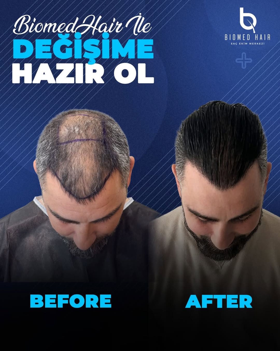 DHI Hair Transplant Result