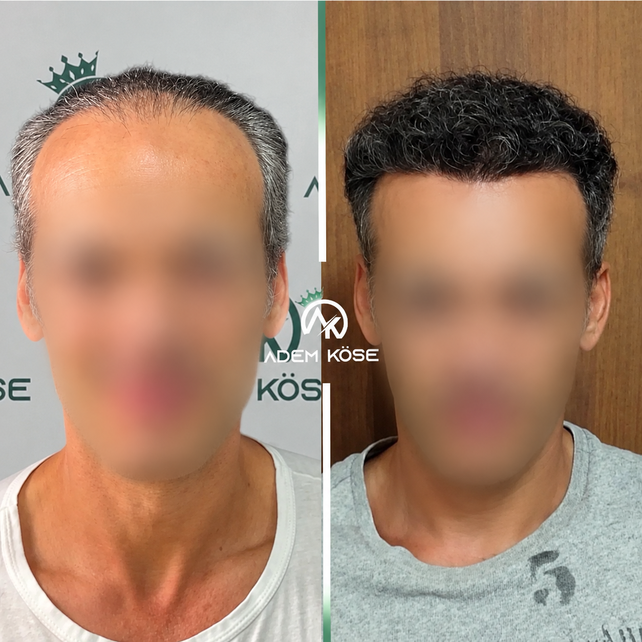 5400 graft DHI hair transplant result before and after