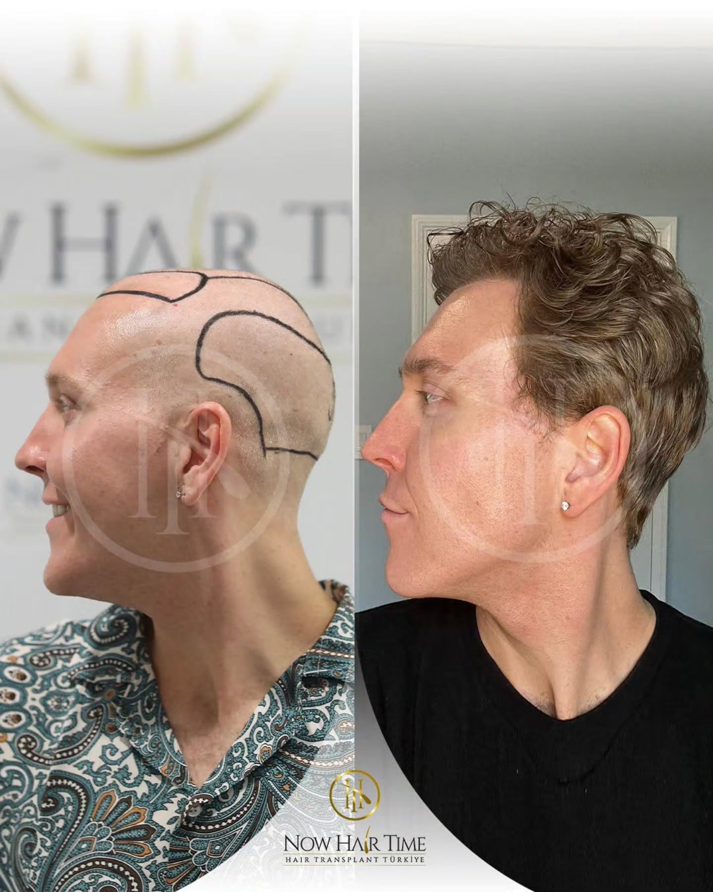 Before and After  graft    transplant at 