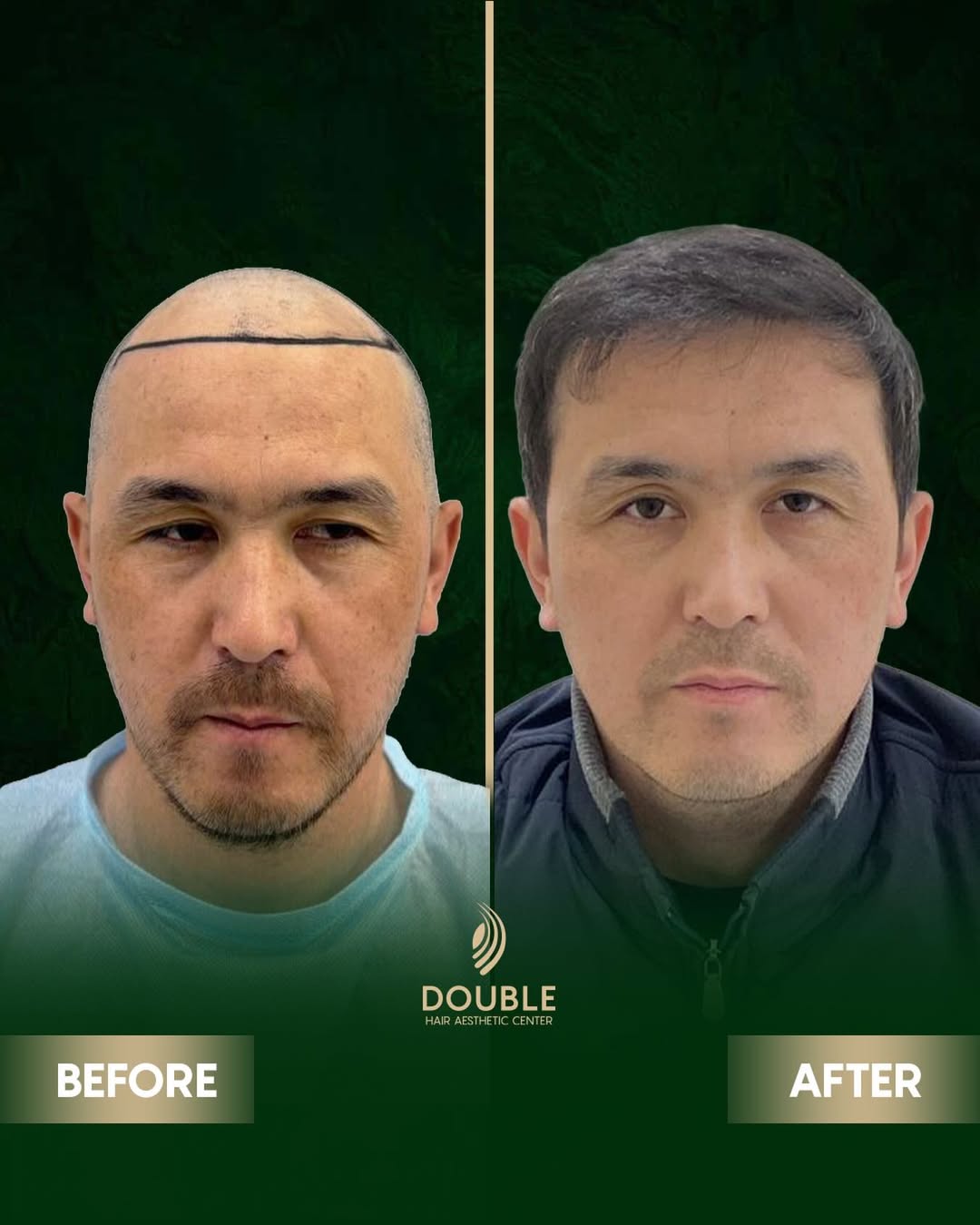FUE Hair Transplant Result