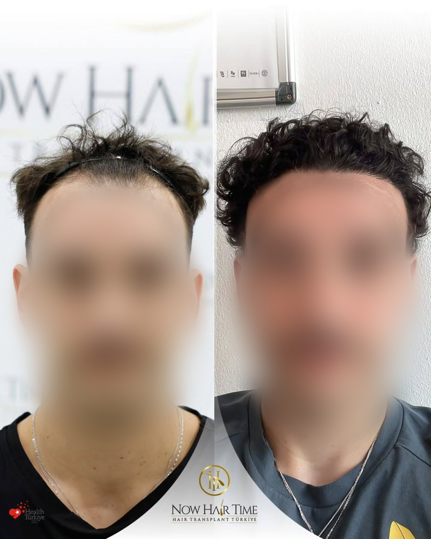 Before and After  graft    transplant at 
