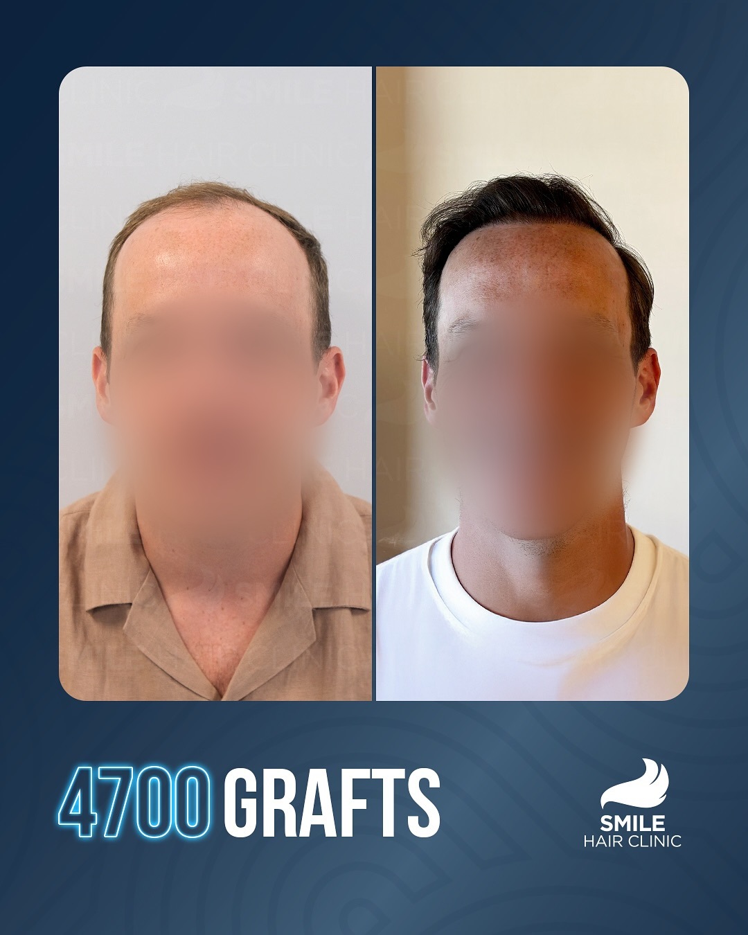 4700 graft FUE hair transplant result before and after