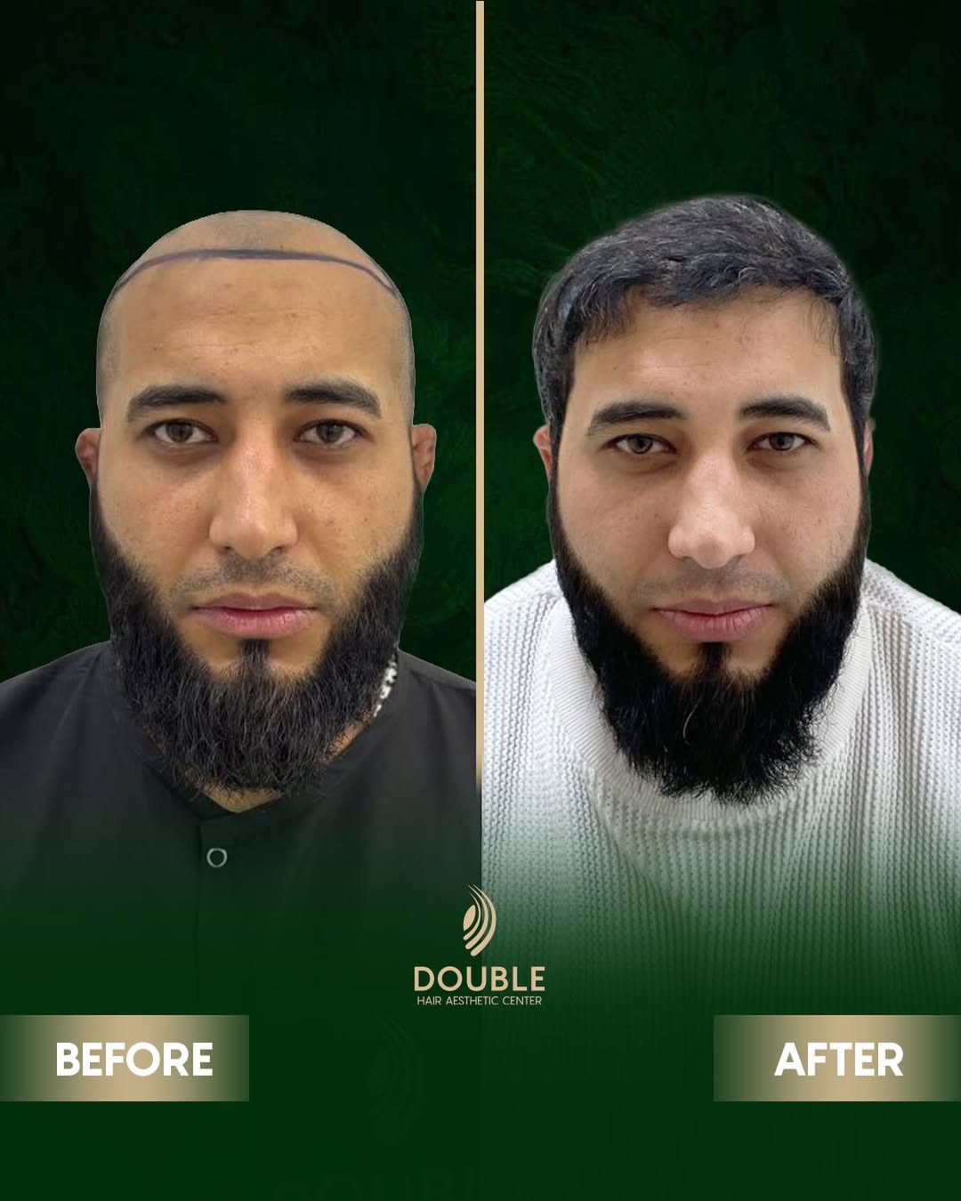 FUE Hair Transplant Result