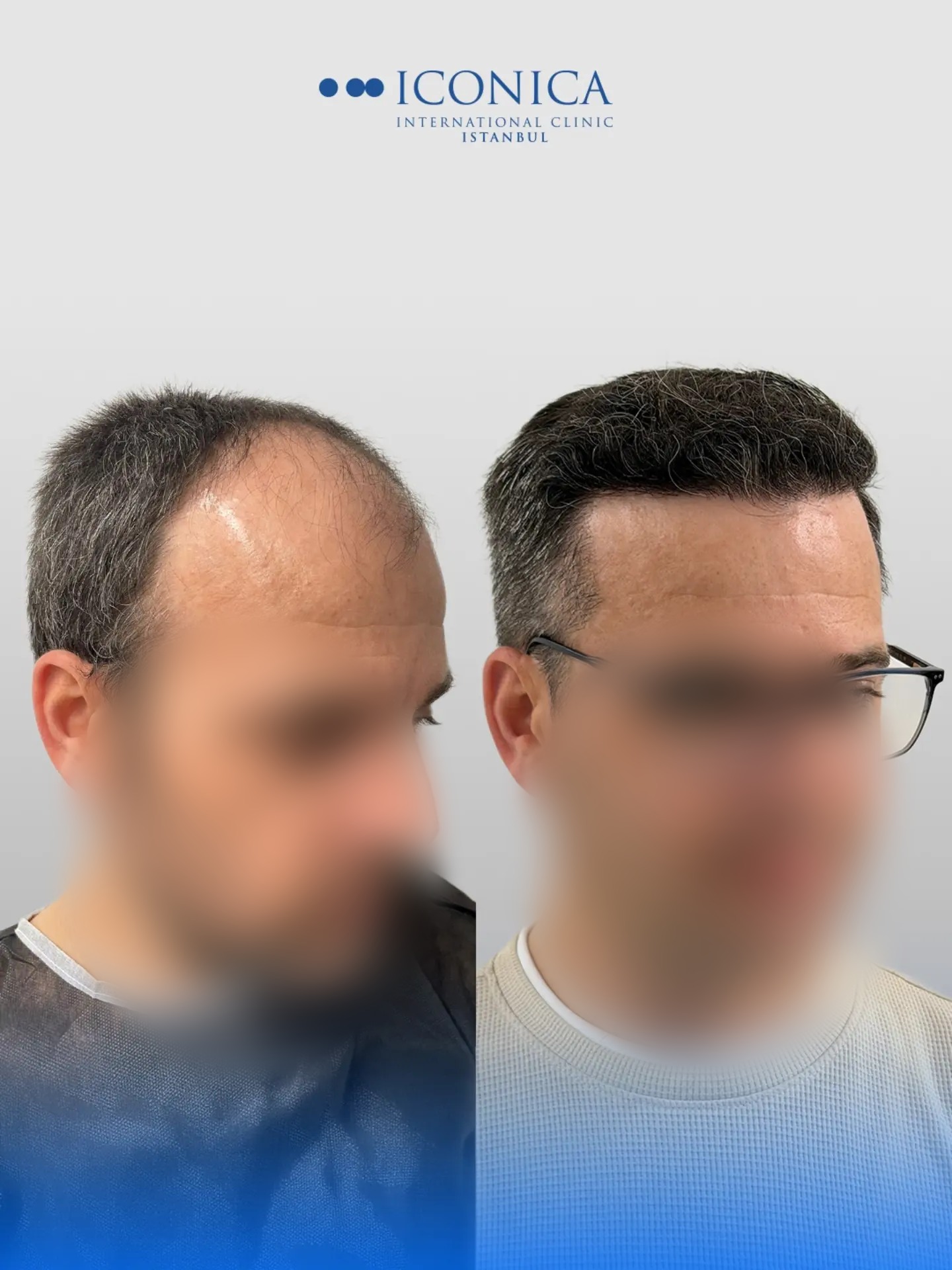 Before and After  graft    transplant at 