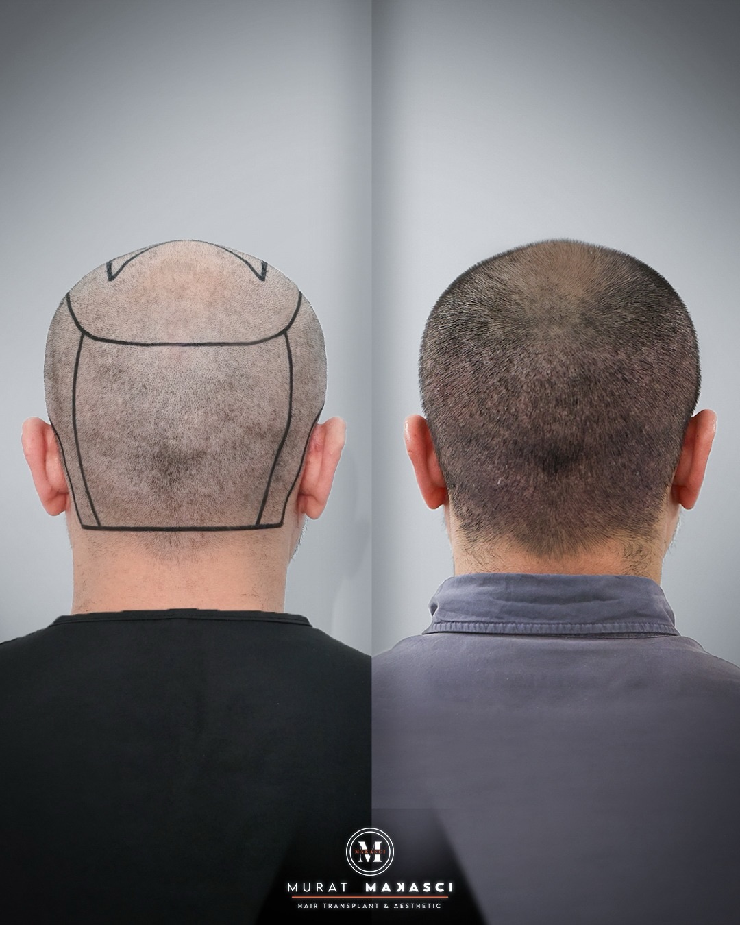 Before and After  graft    transplant at 