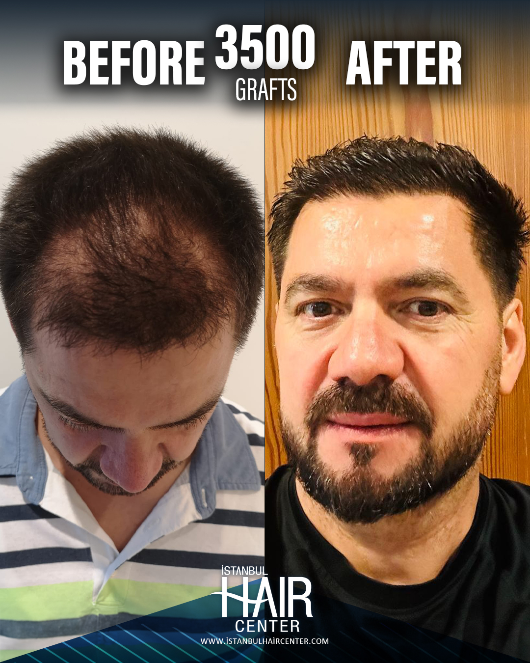 Before and After 3500 graft  DHI hair transplant at Istanbul Hair Center