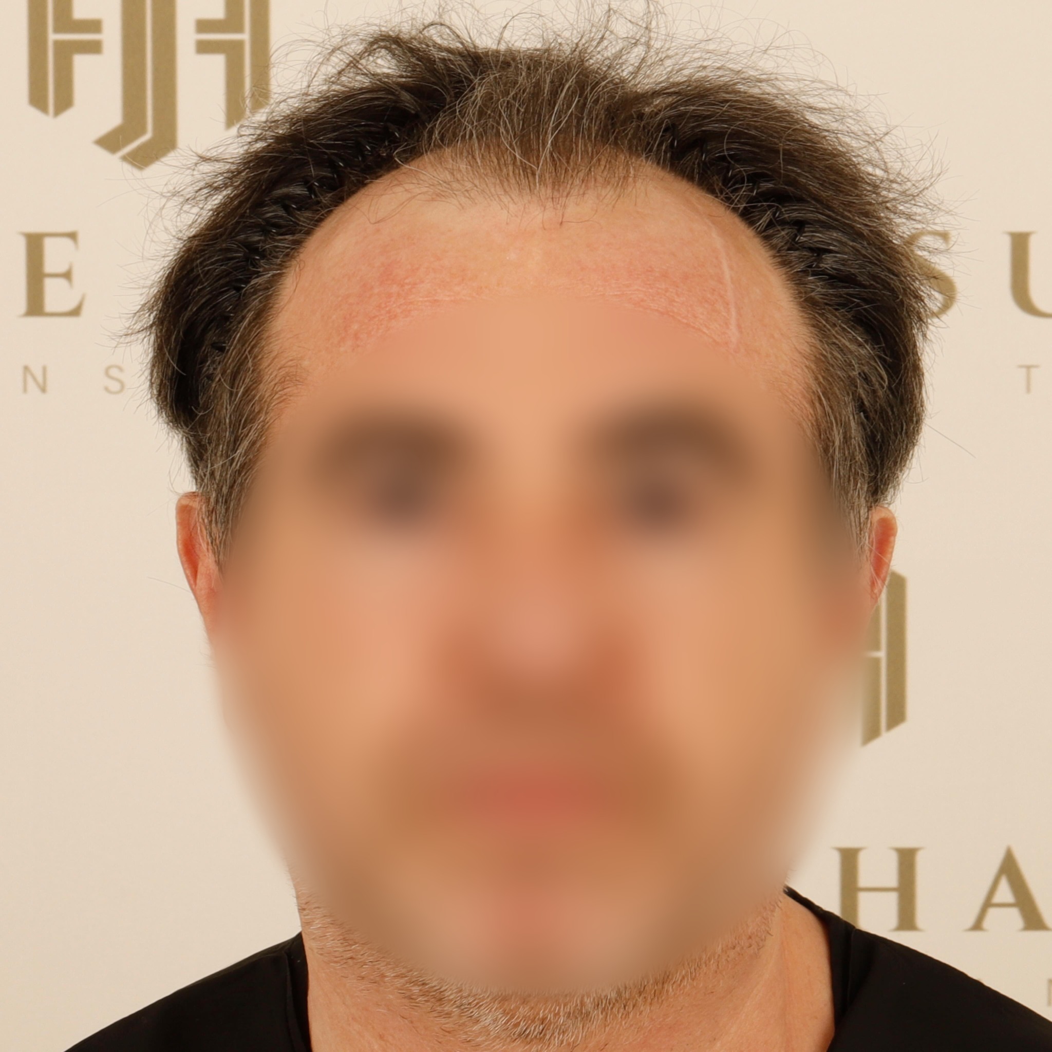 5300 grafts HYBRID hair transplant result before and after