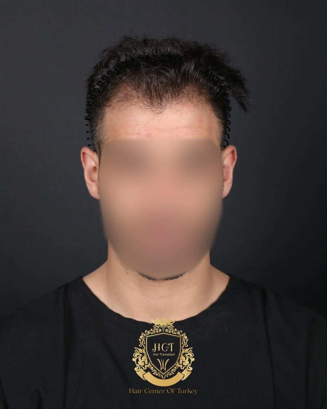 FUE Hair Transplant Result