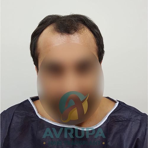 Before and After  graft    transplant at 